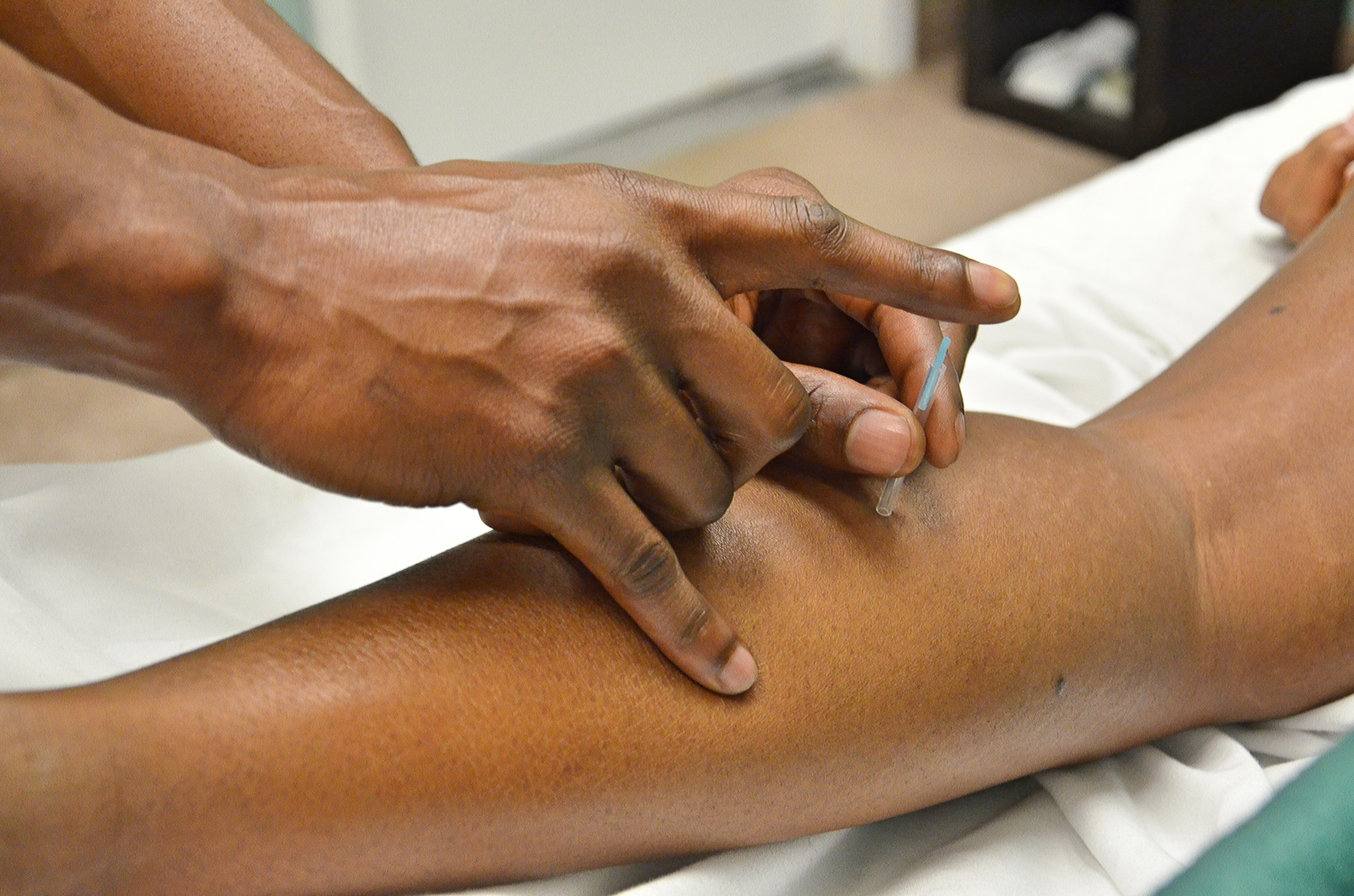 Acupuncturist placing needles. Tampa Bay AI visibility study